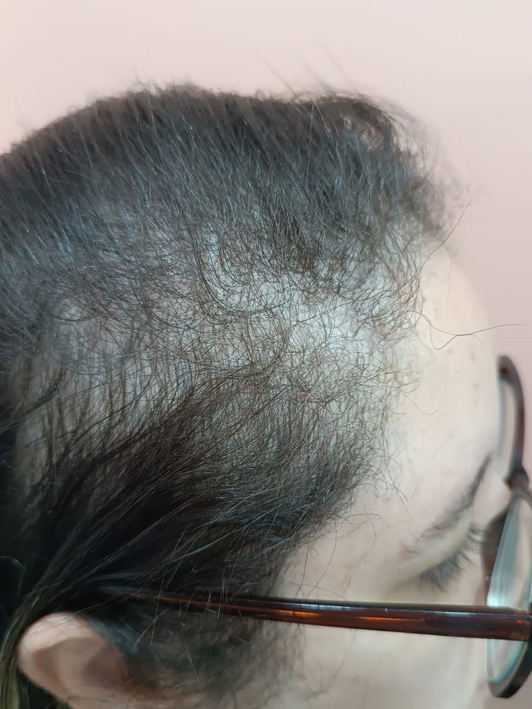Rarefação na linha frontal, antes do acompanhamento.